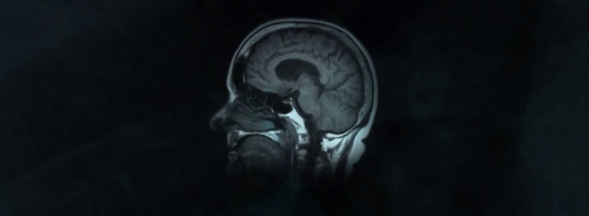 sclerosis_multiplex